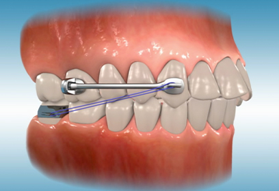 Brace Care for
Carriere appliance