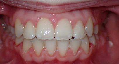 Before & Afters