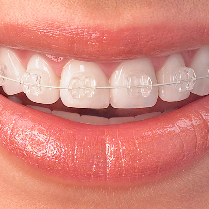 What are clear braces What are clear braces