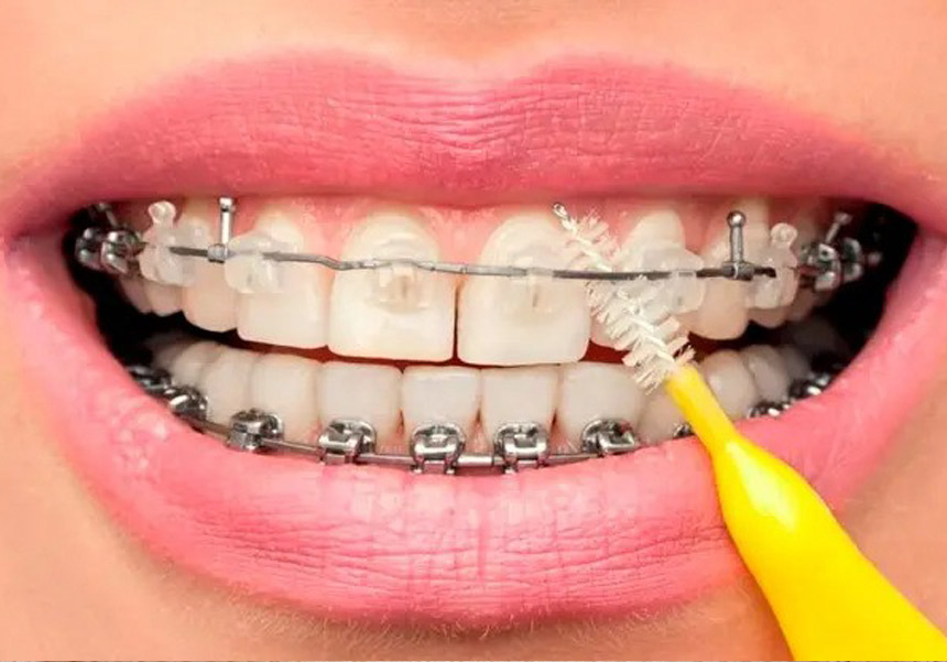 Brace care Brace care
