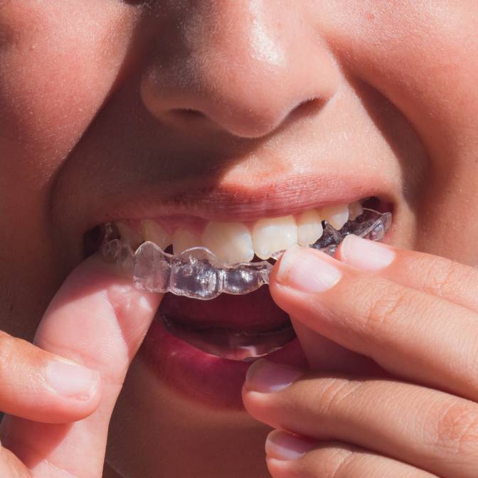 What is Angel Aligner Kid What is Angel Aligner Kid